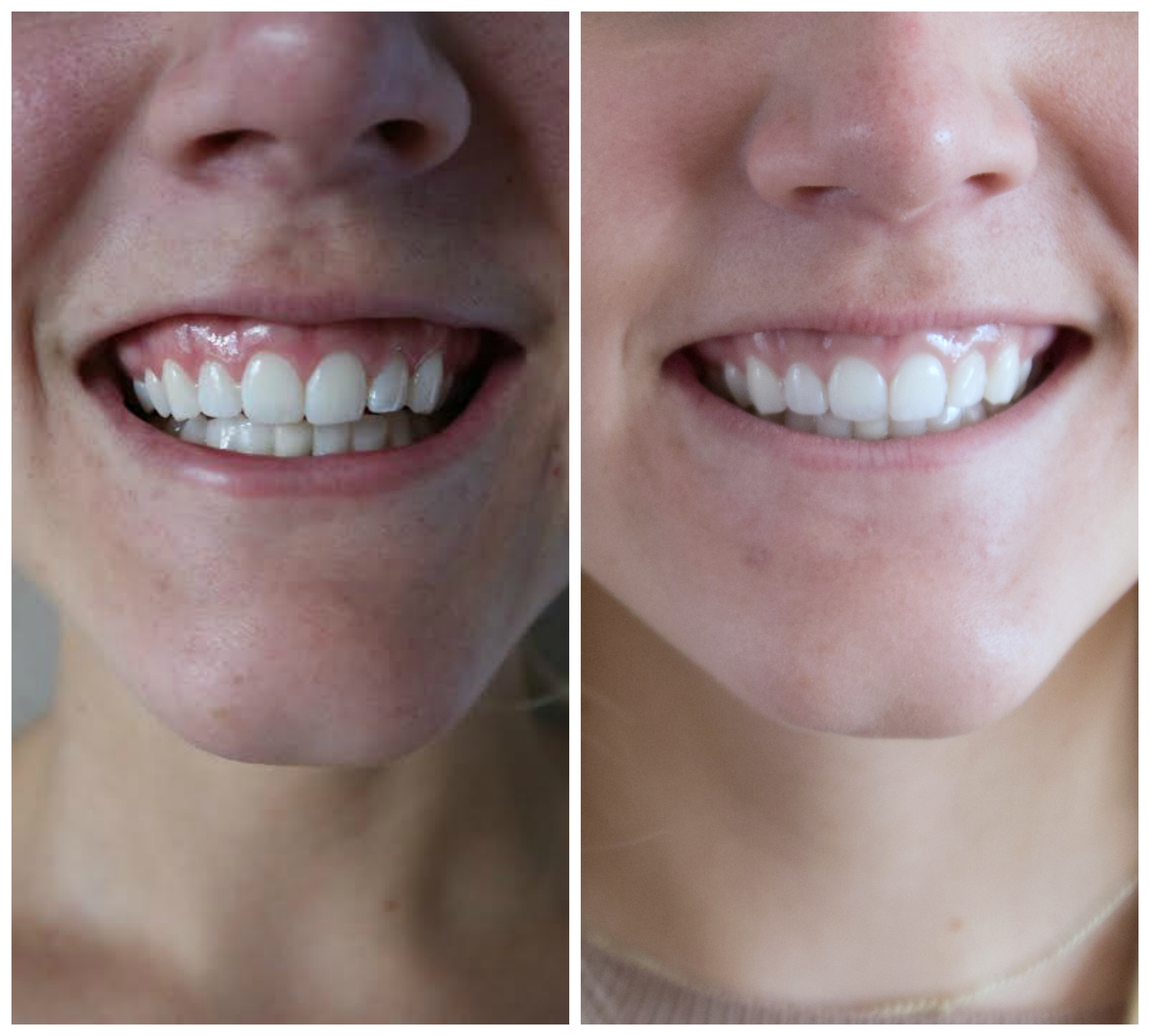 Whitening sensitive teeth at home|| Smile Brilliant
